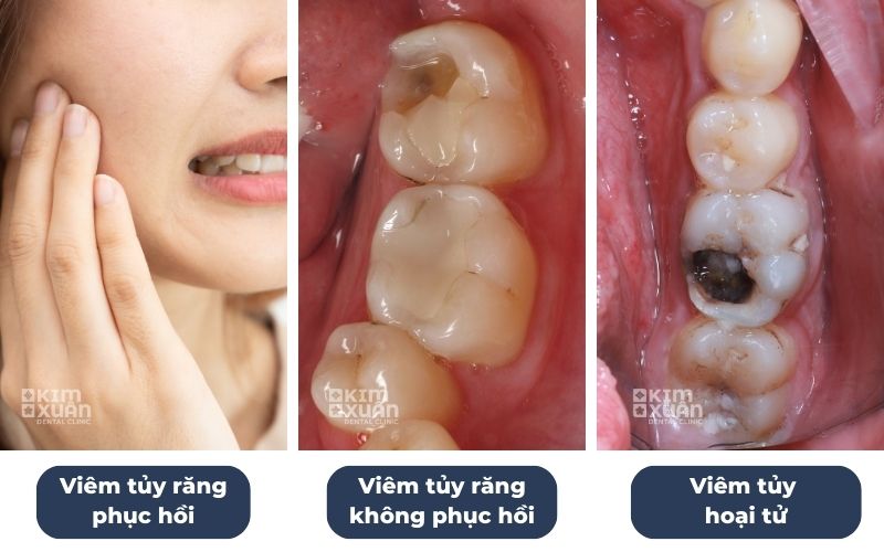 Các Giai Đoạn Viêm Tủy Răng