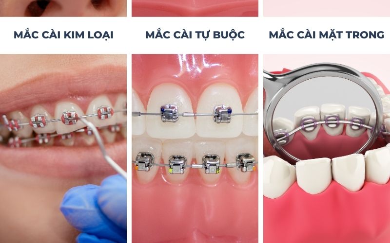 Các Loại Niềng Răng Mắc Cài Kim Loại Hiện Nay