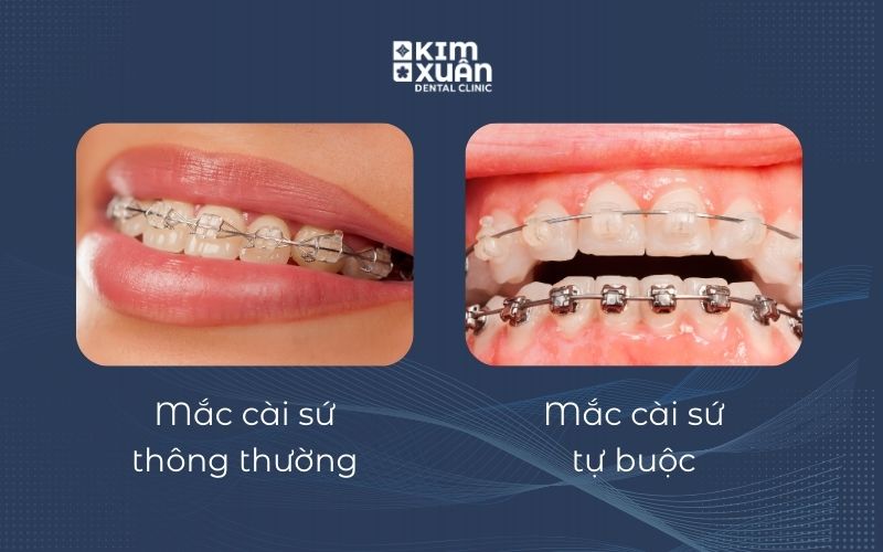 Các Loại Niềng Răng Mắc Cài Phổ Biến Hiện Nay
