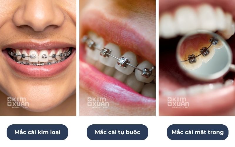 Các Loại Niềng Răng Mắc Cài Phổ Biến Hiện Nay