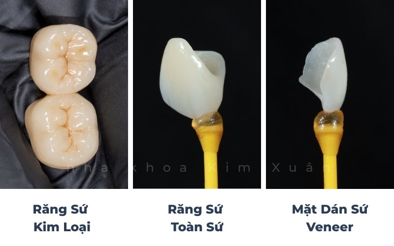 Các Loại Răng Sứ Hiện Nay