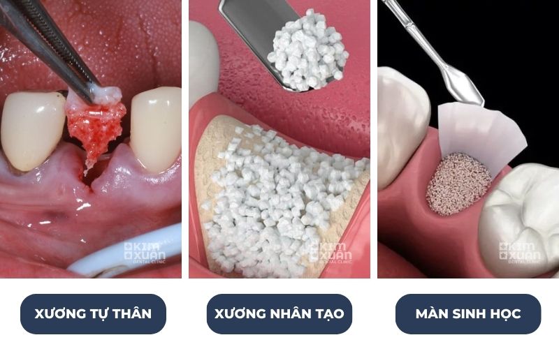 Các Loại Vật Liệu Ghép Xương Trong Implant