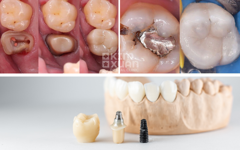 Các Phương Pháp Điều Trị răng Sâu Lỗ To