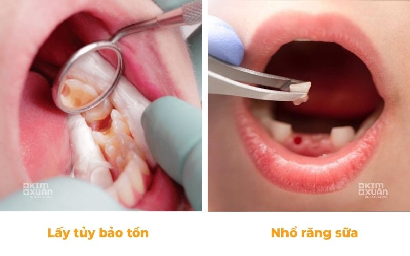 Các phương pháp điều trị viêm tủy răng ở trẻ em