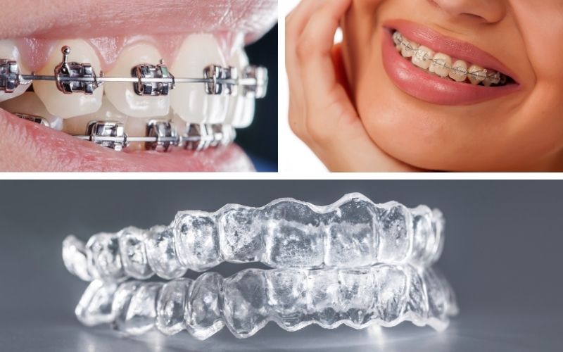 Các Phương Pháp Niềng Răng Chỉnh Nha Tại Nha Khoa Kim Xuân