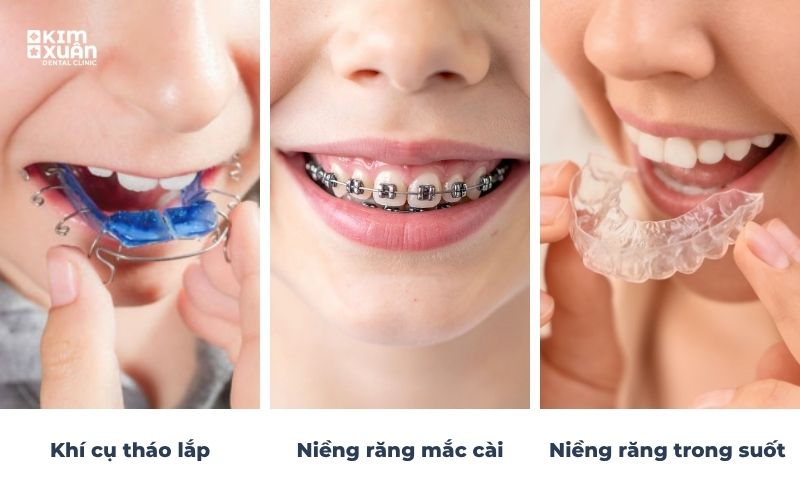 Các Phương Pháp Niềng Răng Cho Trẻ 8 Tuổi