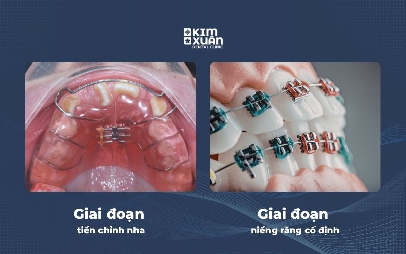 Các Phương Pháp Niềng Răng Cho Trẻ Em