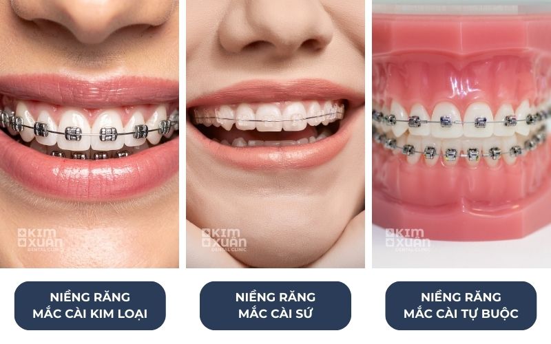 Các Phương Pháp Niềng Răng Hô Hàm Trên