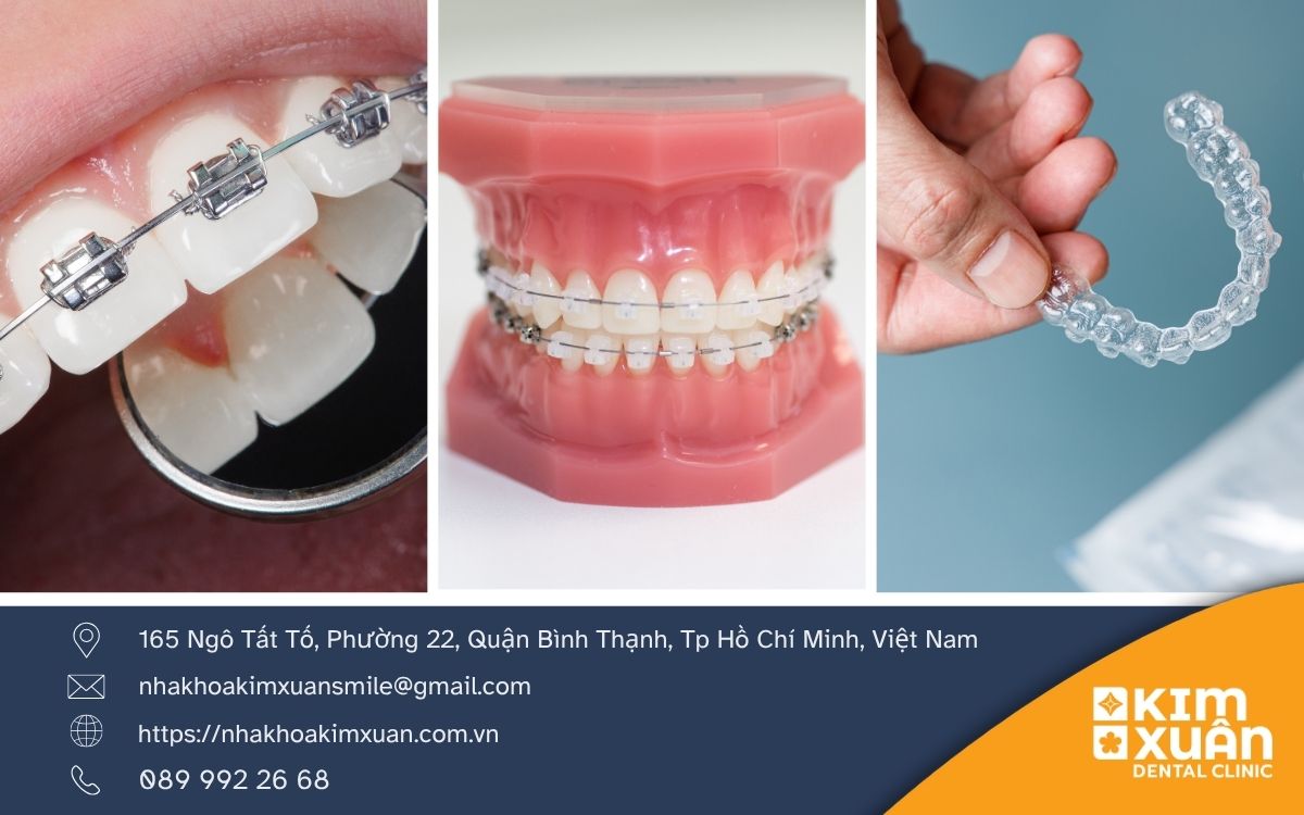 Các Phương Pháo Niềng Răng