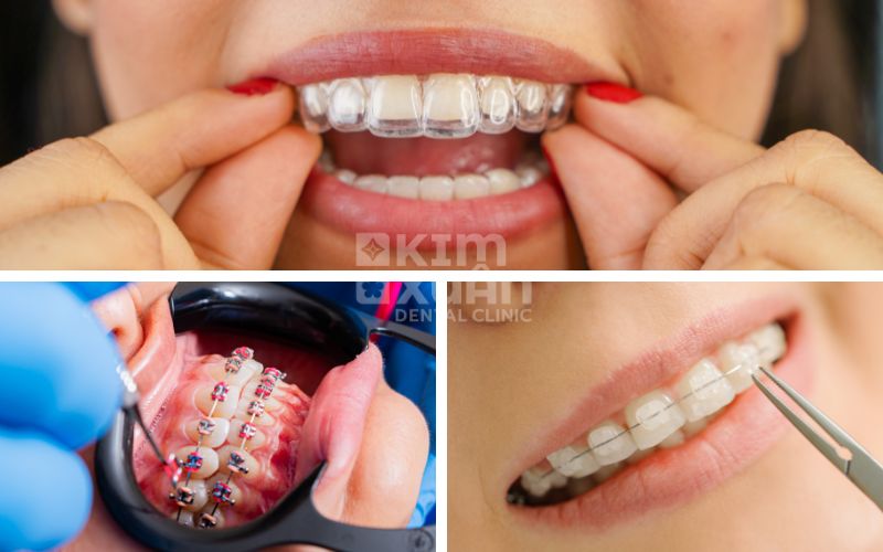 Các phương pháp niềng răng người lớn phổ biến hiện nay