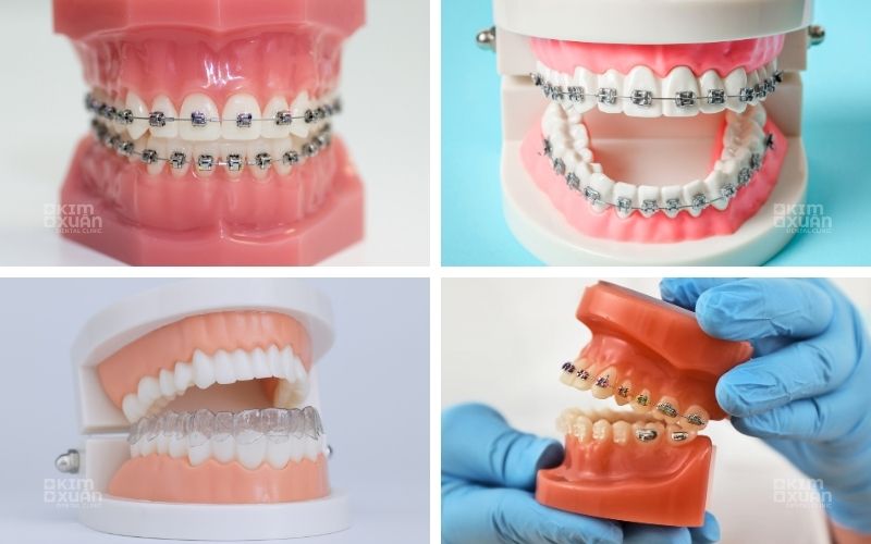 Các phương pháp niềng răng phổ biến hiện nay cho trẻ 15 tuổi 