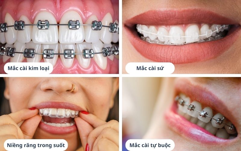Các Phương Pháp Niềng Răng Phổ Biến Ở Tuổi 30