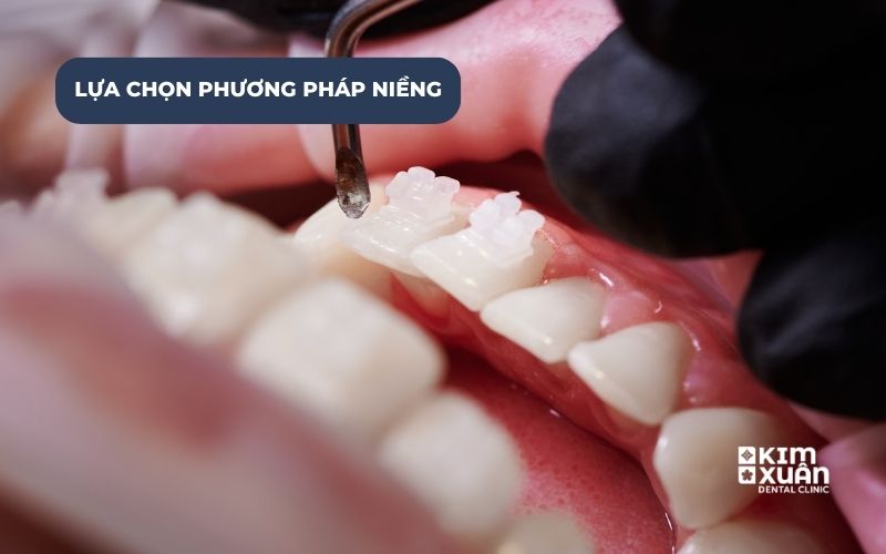 Các Phương Pháp Niềng Răng Phổ Biến