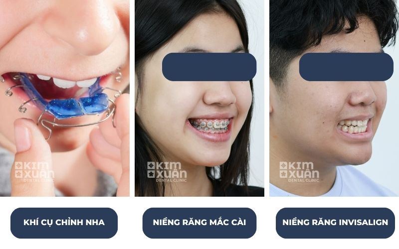 Các Phương Pháp Niềng Răng Trẻ Em Phổ Biến Hiện Nay