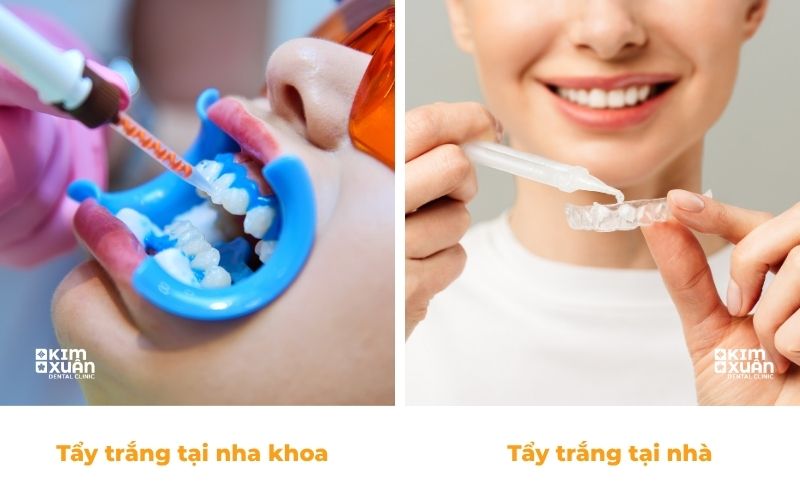 Các phương pháp tẩy trắng răng phổ biến hiện nay