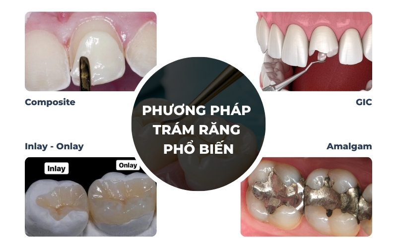 Các Phương Pháp Trám Răng Hiện Nay