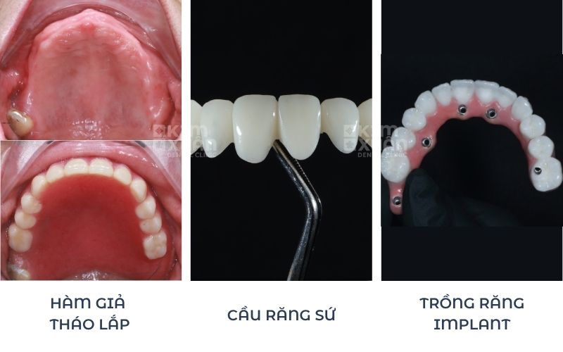 Các Phương Pháp Trồng Răng Giả Cho Người Già