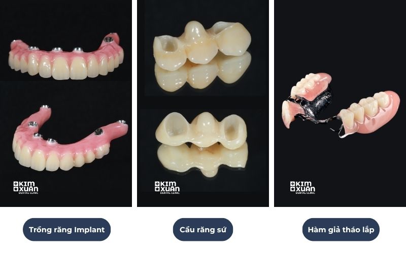 Các Phương Pháp Trồng Răng Giả Hiện Nay