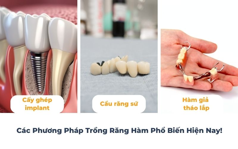 Các Phương Pháp Trồng Răng Hàm Bị Sâu Phổ Biến Hiện Nay
