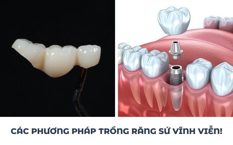 Các Phương Pháp Trồng Răng Sứ Vĩnh Viễn