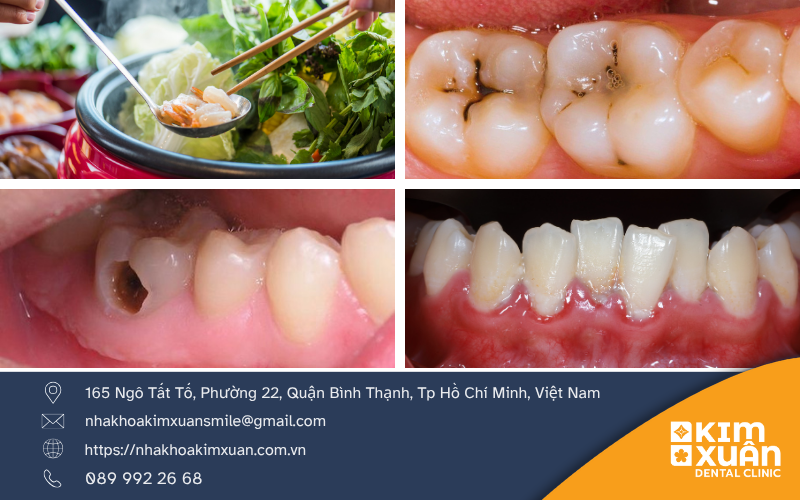 Các Triệu Chứng Khi Bị Sâu Răng Là Gì?