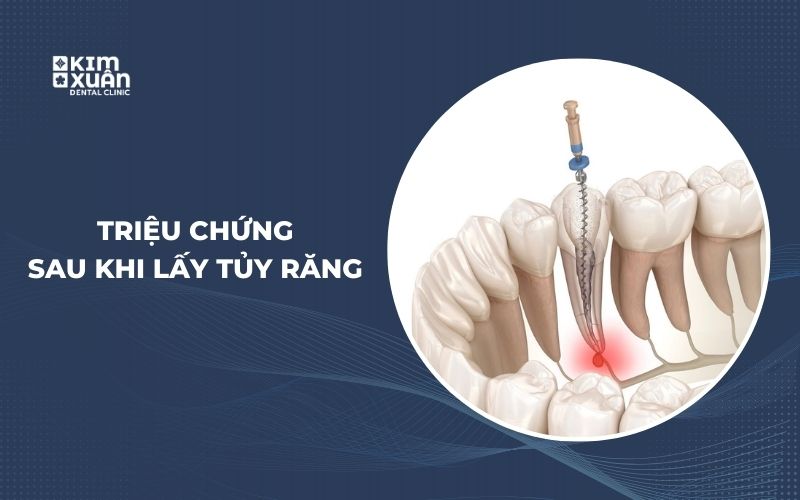 Các Triệu Chứng Thường Gặp Sau Khi Lấy Tủy Răng