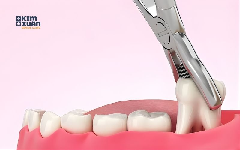 Các Trường Hợp Bắt Buộc Nhổ Răng Cấm