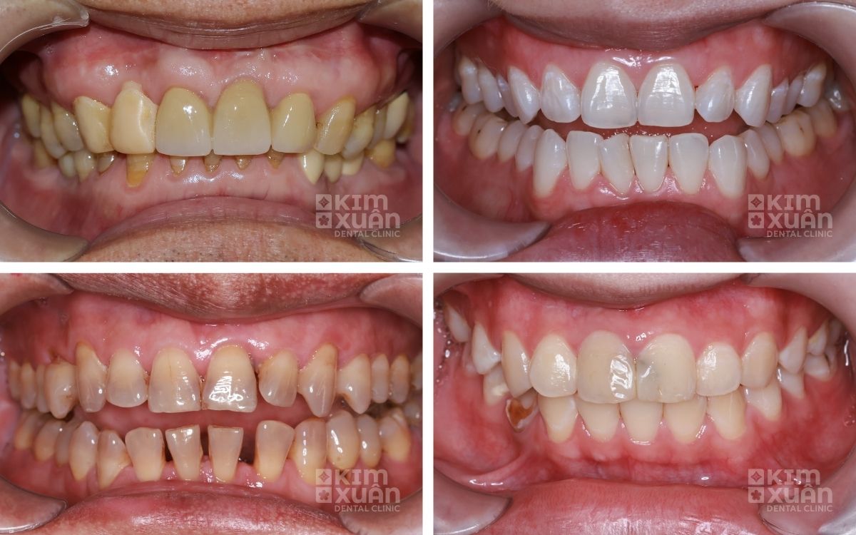 Các Truòng Hợp Nên Dán Răng Sứ Veneer