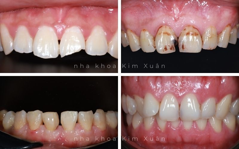 Các Trường Hợp Nên Trám Răng Thẩm Mỹ