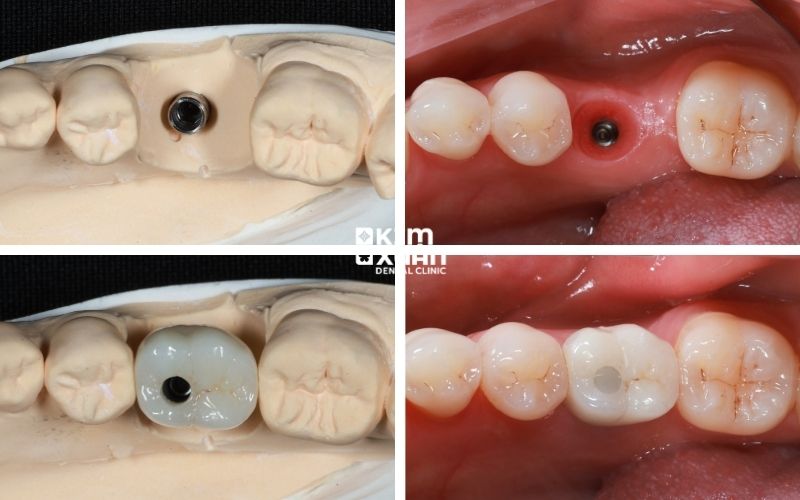 Các Trường Hợp Nên Trồng Răng Impalnt
