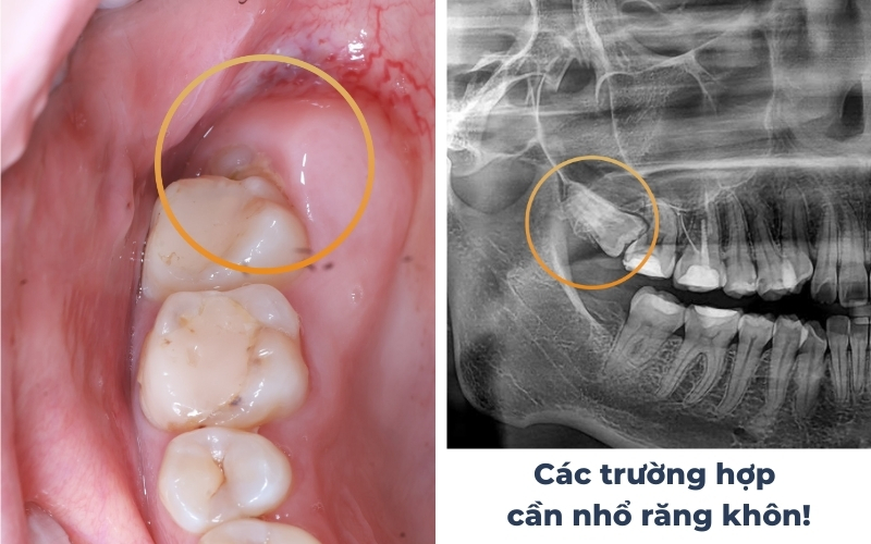 Các Trường Hợp Nhổ Răng Số 8