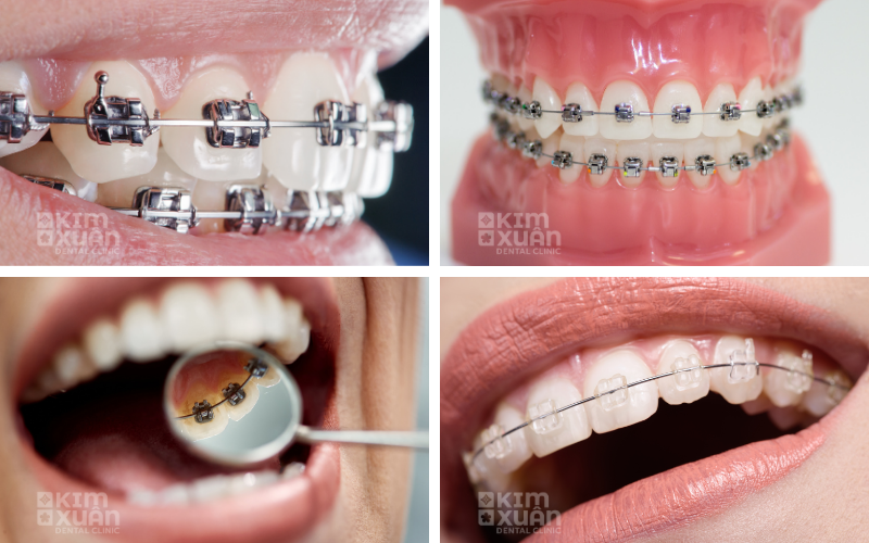 Các Yếu Tố Ảnh Hưởng Đến Chi Phí Niềng Răng