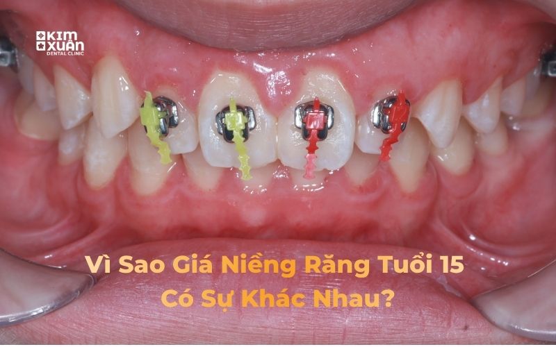 Các yếu tố ảnh hưởng đến chi phí niềng răng ở trẻ 15 tuổi