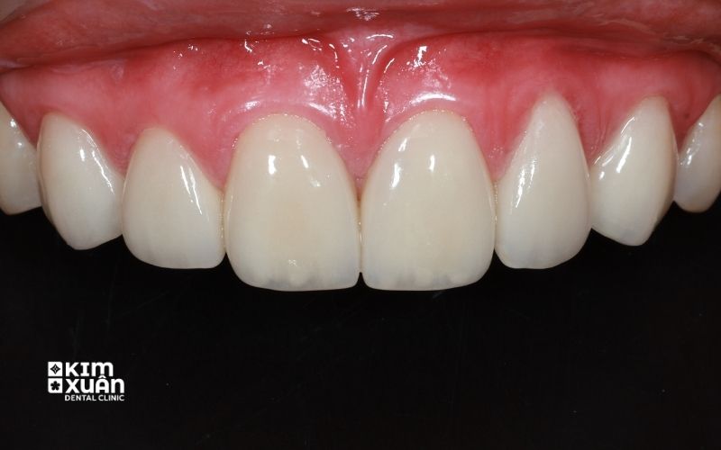 Cách Chăm Sóc Nướu Sau Khi Bọc Răng Sứ