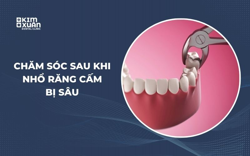 Cách Chăm Sóc Sau Khi Nhổ Răng Cấm Bị Sâu