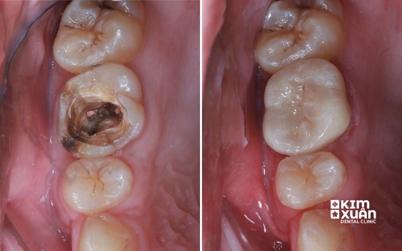 Cách Chữa Trị viêm Tủy Răng Sưng Má