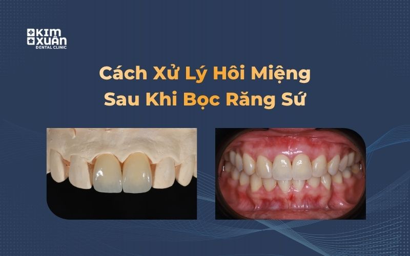 Cách Điều Trị Hôi Miệng Sau Khi Bọc Răng Sứ