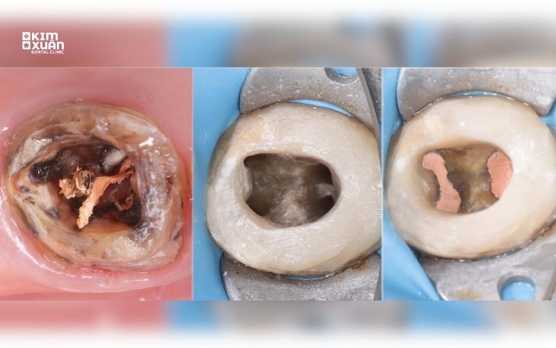 Cách Điều Trị Răng Bị Thối Tủy 