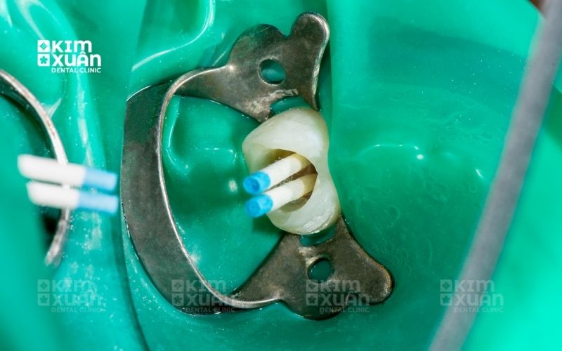 Cách Điều Trị Răng Đã Chết Tủy