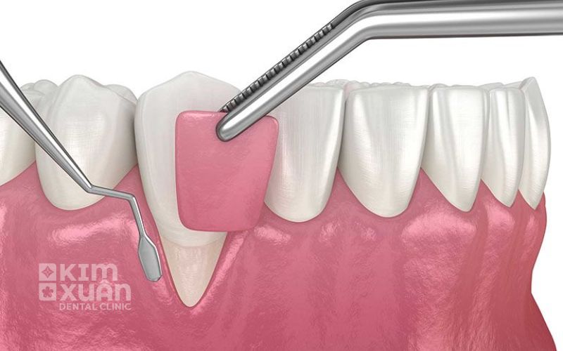 Cách Điều Trị Răng lung Lay