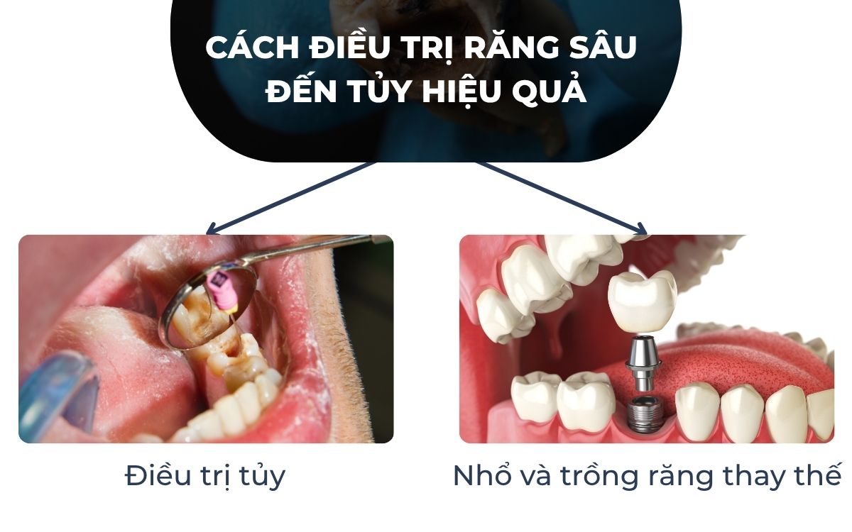 Cách Điều Trị Răng Sâu Đến Tủy Hiệu Quả