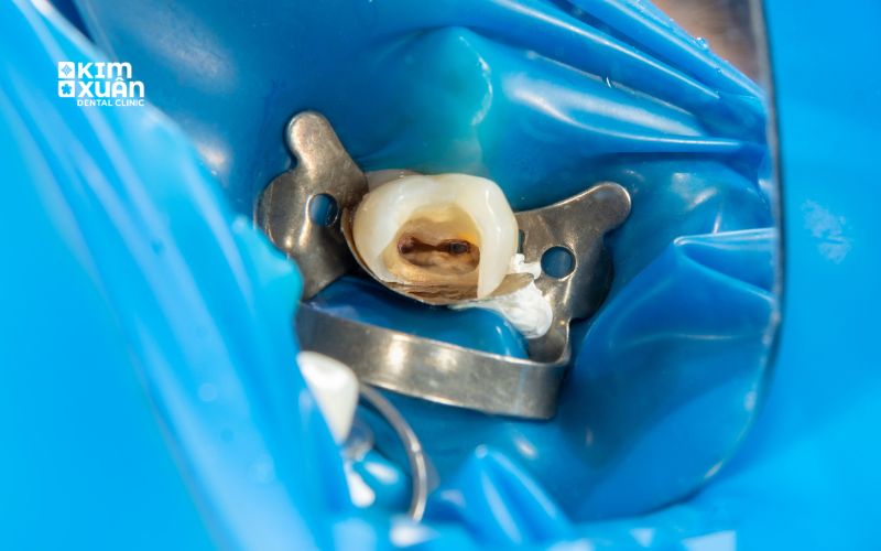 Cách điều trị sâu răng ở trẻ em
