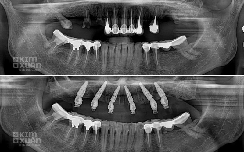 Cách Điều Trị Tiêu Xương Hàm Hiệu Quả