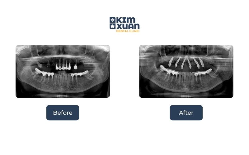 Cách Điều Trị Tiêu Xương Hàm Hiệu Quả