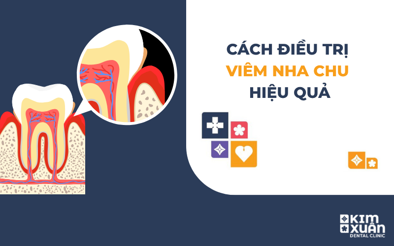 Cách Điều Trị Viêm Nha Chu