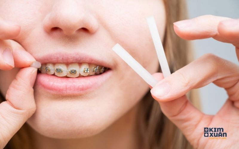 Cách Giảm Đau Niềng Răng Hiệu Quả