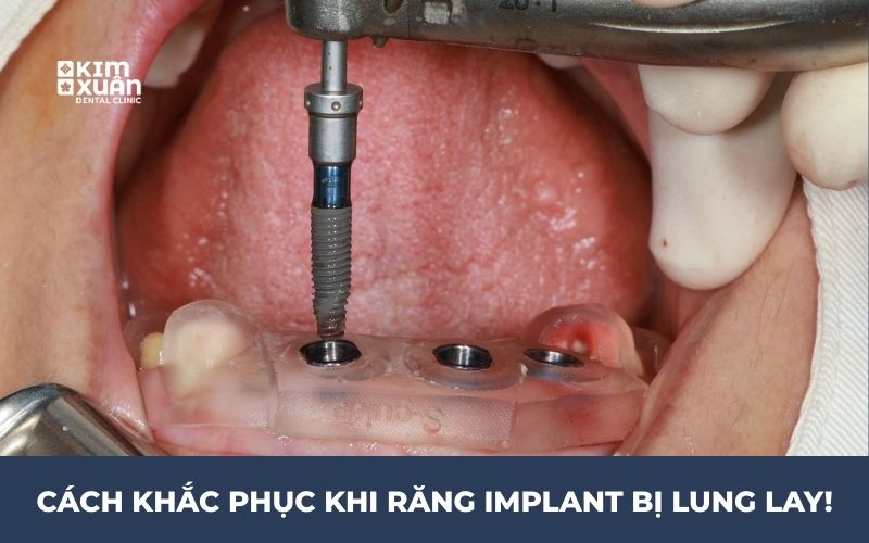 Cách Khắc Phục Răng Implant Bị Lung Lay