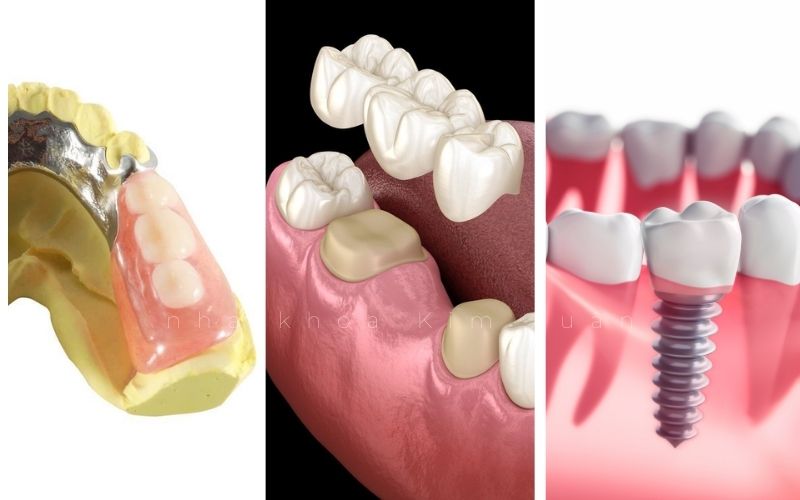 Cách Khắc Phục Tình Trạng Khi Còn Chân Răng