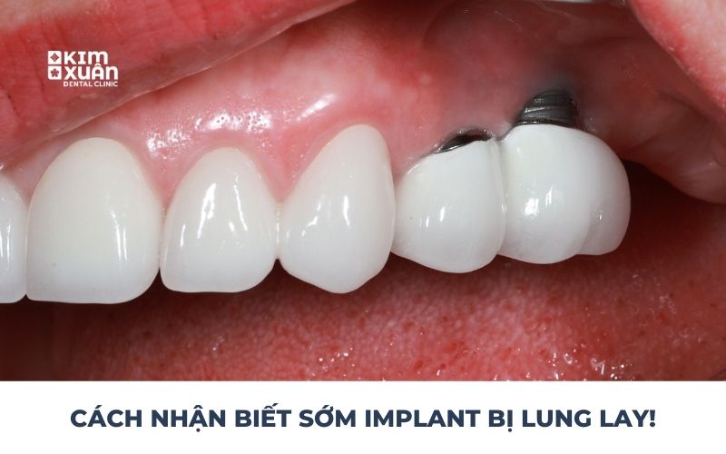 Cách Nhận Biết Răng Implant Bị Lung Lay