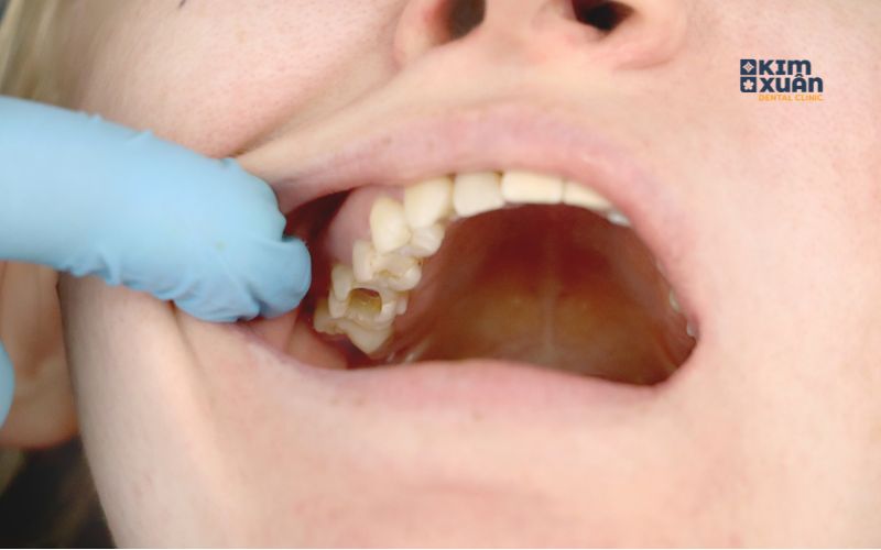 Cách phòng ngừa sâu răng ở trẻ em
